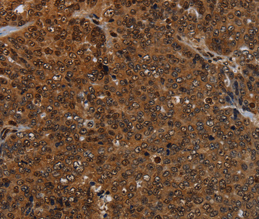 Immunohistochemistry of paraffin-embedded Human ovarian cancer tissue using KDM4B Polyclonal Antibody at dilution 1:50