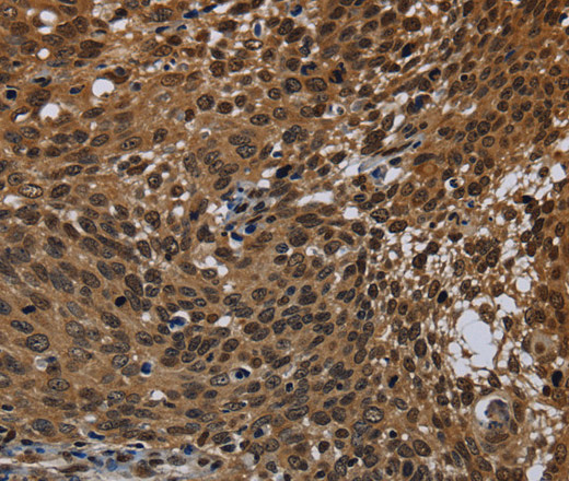 Immunohistochemistry of paraffin-embedded Human cervical cancer tissue using KDM4B Polyclonal Antibody at dilution 1:50