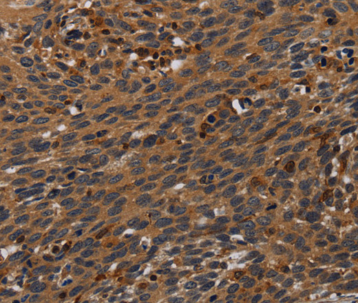 Immunohistochemistry of paraffin-embedded Human cervical cancer tissue using PCDHB15 Polyclonal Antibody at dilution 1:50