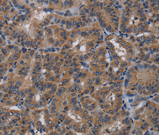 Immunohistochemistry of paraffin-embedded Human thyroid cancer using PDE4A Polyclonal Antibody at dilution of 1:40