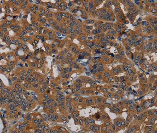 Immunohistochemistry of paraffin-embedded Human thyroid cancer tissue using PDE5A Polyclonal Antibody at dilution 1:50