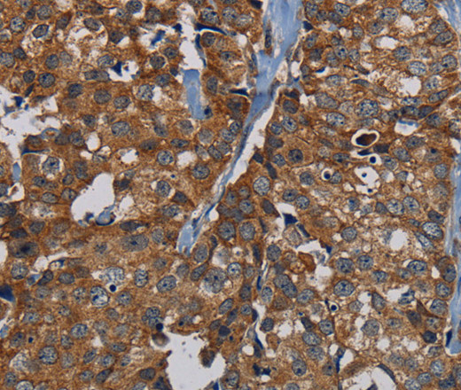 Immunohistochemistry of paraffin-embedded Human breast cancer tissue using PDE5A Polyclonal Antibody at dilution 1:50