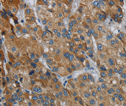 Immunohistochemistry of paraffin-embedded Human liver cancer using PDSS2 Polyclonal Antibody at dilution of 1:30