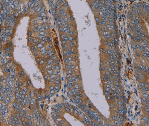 Immunohistochemistry of paraffin-embedded Human colon cancer tissue using PYY Polyclonal Antibody at dilution 1:40