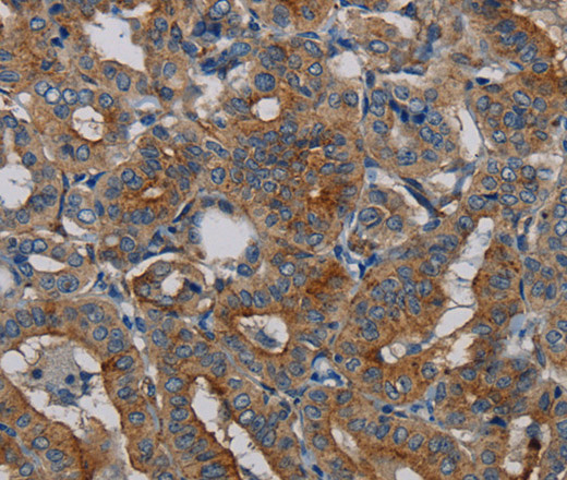 Immunohistochemistry of paraffin-embedded Human thyroid cancer tissue using PER2 Polyclonal Antibody at dilution 1:50