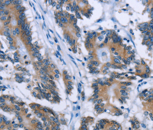 Immunohistochemistry of paraffin-embedded Human colon cancer tissue using PLIN1 Polyclonal Antibody at dilution 1:30