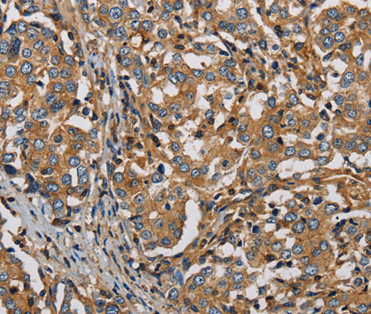 Immunohistochemistry of paraffin-embedded Human liver cancer tissue using PLIN3 Polyclonal Antibody at dilution 1:50