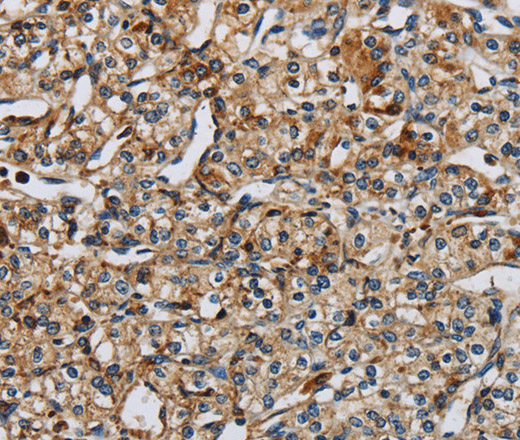 Immunohistochemistry of paraffin-embedded Human prostate cancer tissue using PERK Polyclonal Antibody at dilution 1:50