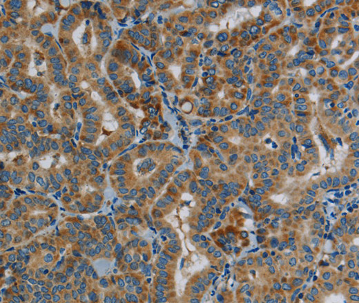 Immunohistochemistry of paraffin-embedded Human thyroid cancer tissue using PPARGC1B Polyclonal Antibody at dilution 1:30