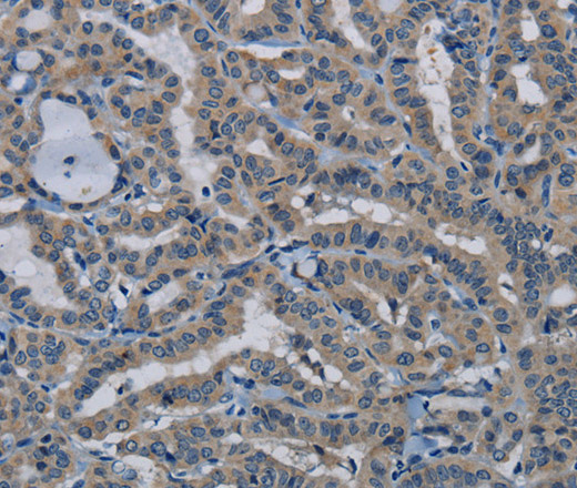 Immunohistochemistry of paraffin-embedded Human thyroid cancer tissue using PIK3CB Polyclonal Antibody at dilution 1:50