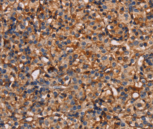 Immunohistochemistry of paraffin-embedded Human prostate cancer tissue using PLXNA1 Polyclonal Antibody at dilution 1:30