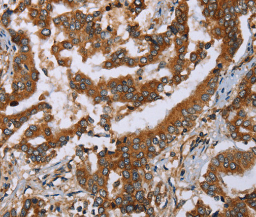 Immunohistochemistry of paraffin-embedded Human liver cancer tissue using PLXNB1 Polyclonal Antibody at dilution 1:50