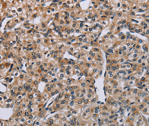 Immunohistochemistry of paraffin-embedded Human prostate cancer tissue using PNPT1 Polyclonal Antibody at dilution 1:40