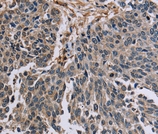 Immunohistochemistry of paraffin-embedded Human lung cancer tissue using PNPT1 Polyclonal Antibody at dilution 1:40