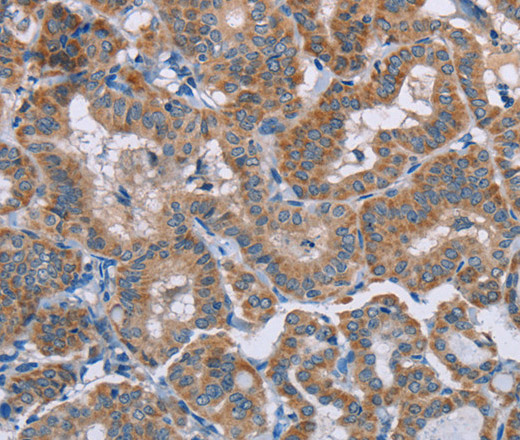 Immunohistochemistry of paraffin-embedded Human thyroid cancer using POMT1 Polyclonal Antibody at dilution of 1:50