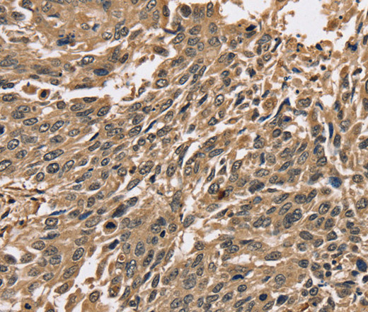 Immunohistochemistry of paraffin-embedded Human lung cancer using PPP1CC Polyclonal Antibody at dilution of 1:40