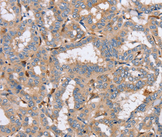 Immunohistochemistry of paraffin-embedded Human thyroid cancer using PPM1F Polyclonal Antibody at dilution of 1:40