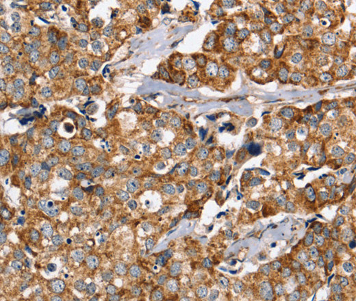 Immunohistochemistry of paraffin-embedded Human breast cancer using PPOX Polyclonal Antibody at dilution of 1:40