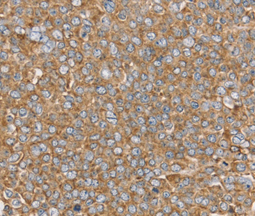 Immunohistochemistry of paraffin-embedded Human ovarian cancer using PTGER2 Polyclonal Antibody at dilution of 1:45