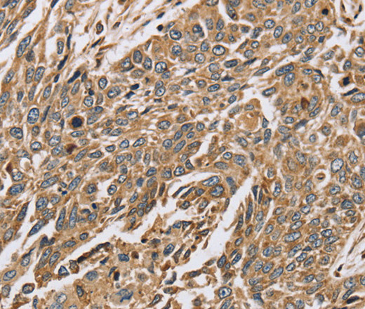 Immunohistochemistry of paraffin-embedded Human lung cancer using PTGER2 Polyclonal Antibody at dilution of 1:45