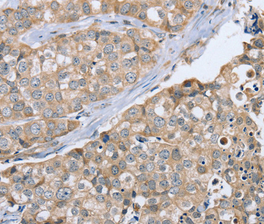 Immunohistochemistry of paraffin-embedded Human breast cancer using CYTH1 Polyclonal Antibody at dilution of 1:40