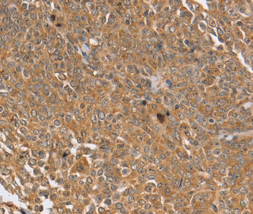 Immunohistochemistry of paraffin-embedded Human cervical cancer using PTPN20 Polyclonal Antibody at dilution of 1:30