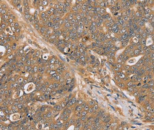 Immunohistochemistry of paraffin-embedded Human ovarian cancer using PTPN20 Polyclonal Antibody at dilution of 1:30