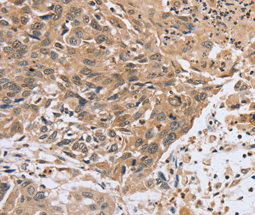 Immunohistochemistry of paraffin-embedded Human lung cancer tissue using PTPN4 Polyclonal Antibody at dilution 1:40