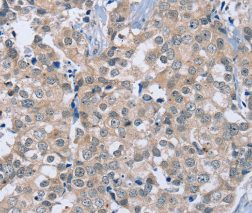 Immunohistochemistry of paraffin-embedded Human breast cancer using RAB8B Polyclonal Antibody at dilution of 1:40