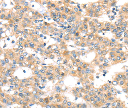 Immunohistochemistry of paraffin-embedded Human breast cancer tissue using RAB24 Polyclonal Antibody at dilution 1:45