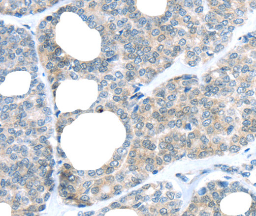 Immunohistochemistry of paraffin-embedded Human thyroid cancer tissue using RAB24 Polyclonal Antibody at dilution 1:45