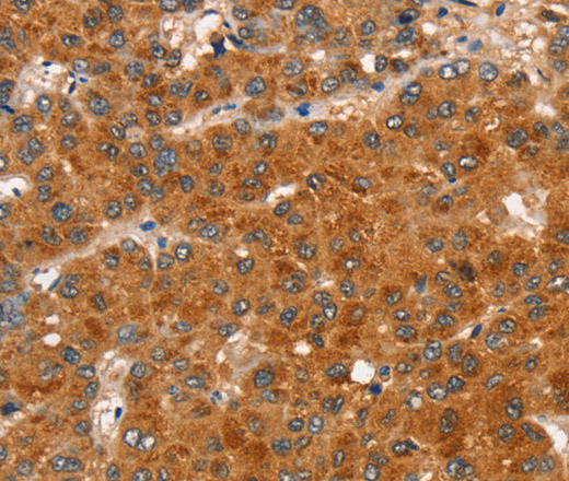 Immunohistochemistry of paraffin-embedded Human liver cancer tissue using RASA3 Polyclonal Antibody at dilution 1:35