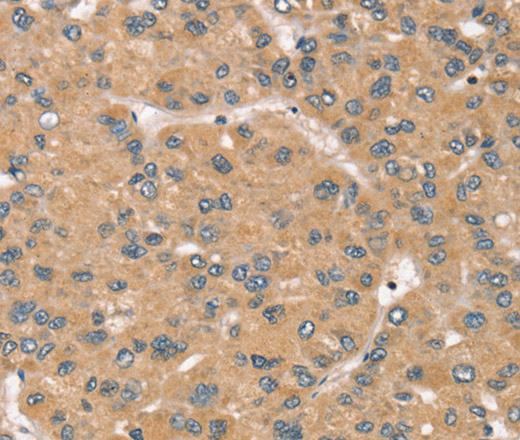 Immunohistochemistry of paraffin-embedded Human liver cancer tissue using RBM38 Polyclonal Antibody at dilution 1:45