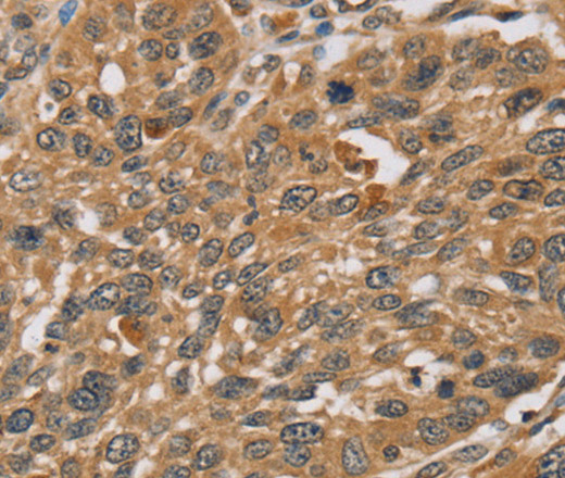 Immunohistochemistry of paraffin-embedded Human lung cancer using RNF5 Polyclonal Antibody at dilution of 1:35