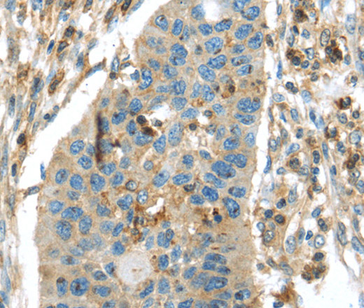 Immunohistochemistry of paraffin-embedded Human breast cancer tissue using RIPK4 Polyclonal Antibody at dilution 1:40