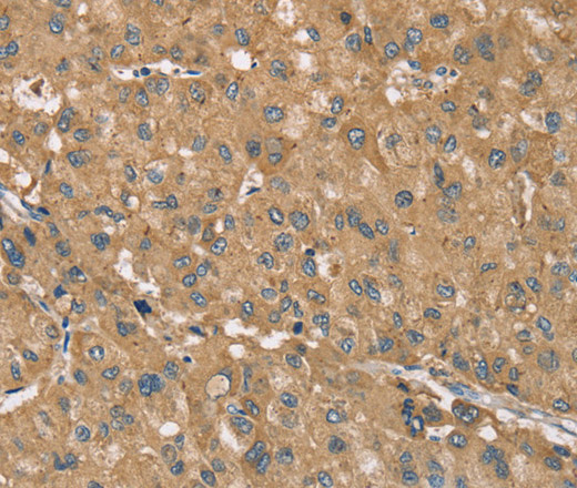 Immunohistochemistry of paraffin-embedded Human liver cancer tissue using RNF148 Polyclonal Antibody at dilution 1:40