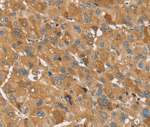 Immunohistochemistry of paraffin-embedded Human liver cancer using TRIM34 Polyclonal Antibody at dilution of 1:30