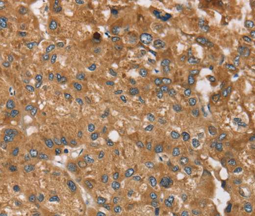 Immunohistochemistry of paraffin-embedded Human liver cancer tissue using RPS6KA2 Polyclonal Antibody at dilution 1:40