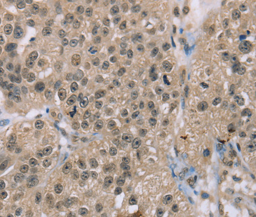 Immunohistochemistry of paraffin-embedded Human breast cancer using ACTN2 Polyclonal Antibody at dilution of 1:30