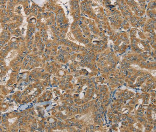 Immunohistochemistry of paraffin-embedded Human thyroid cancer using SDHB Polyclonal Antibody at dilution of 1:30