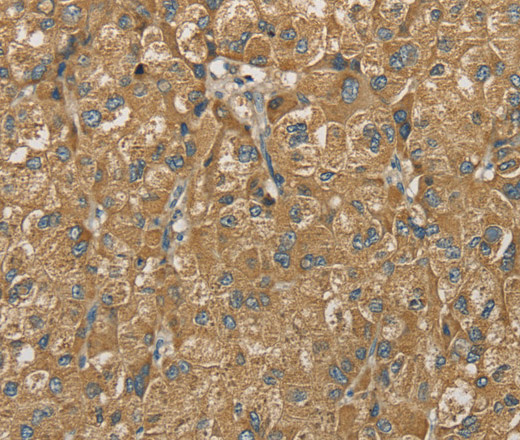 Immunohistochemistry of paraffin-embedded Human liver cancer using SDHB Polyclonal Antibody at dilution of 1:30