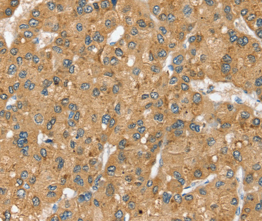 Immunohistochemistry of paraffin-embedded Human liver cancer using SEC14L2 Polyclonal Antibody at dilution of 1:40