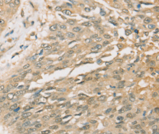 Immunohistochemistry of paraffin-embedded Human lung cancer tissue using SIGLEC15 Polyclonal Antibody at dilution 1:35