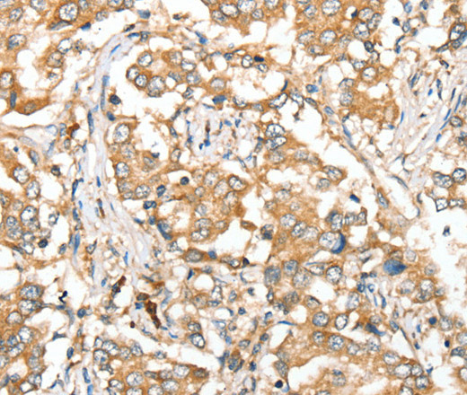 Immunohistochemistry of paraffin-embedded Human liver cancer tissue using SIRT4 Polyclonal Antibody at dilution 1:35