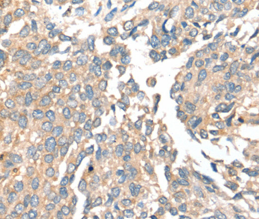 Immunohistochemistry of paraffin-embedded Human lung cancer tissue using SIRT4 Polyclonal Antibody at dilution 1:35