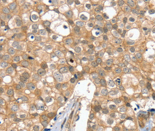 Immunohistochemistry of paraffin-embedded Human breast cancer tissue using SLC6A7 Polyclonal Antibody at dilution 1:30