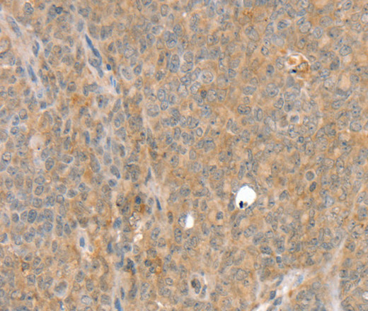 Immunohistochemistry of paraffin-embedded Human ovarian cancer tissue using SLC8A3 Polyclonal Antibody at dilution 1:35