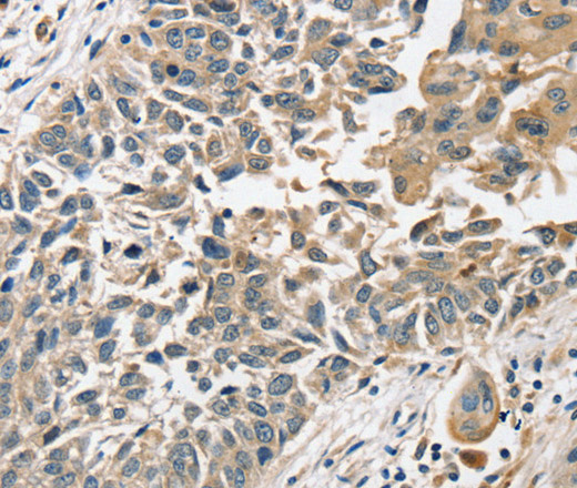 Immunohistochemistry of paraffin-embedded Human lung cancer tissue using SLC8A3 Polyclonal Antibody at dilution 1:35