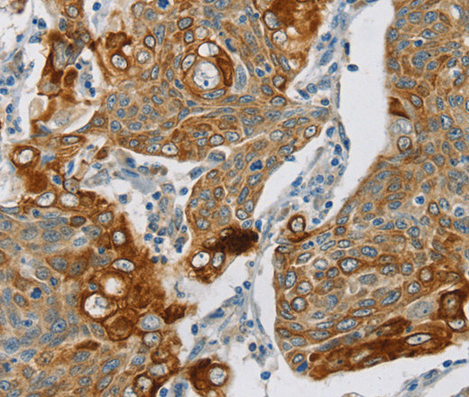 Immunohistochemistry of paraffin-embedded Human cervical cancer using SMOC2 Polyclonal Antibody at dilution of 1:30