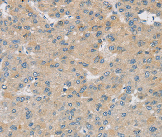 Immunohistochemistry of paraffin-embedded Human liver cancer using SMOC2 Polyclonal Antibody at dilution of 1:30